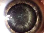Cataract Cataract