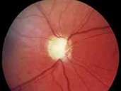 Green star: advanced stage glaucoma with already severely damaged optic nerve. Green star: advanced stage glaucoma with already severely damaged optic nerve.