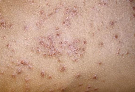 Eczema and infections