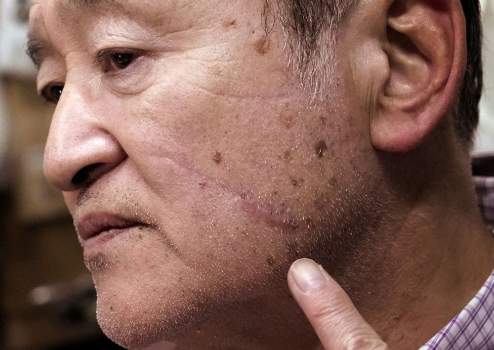 Keiji Minatoya, 68, a confectionery shop owner who was attacked by a black bear in front of the garage in his backyard on October 19, 2023, points to a scar on his face from the attack, during an interview with Reuters in Kitaakita, Akita Prefecture, Japan, November 6, 2025. — Reuters pic Keiji Minatoya, 68, a confectionery shop owner who was attacked by a black bear in front of the garage in his backyard on October 19, 2023, points to a scar on his face from the attack, during an interview with Reuters in Kitaakita, Akita Prefecture, Japan, November 6, 2025. — Reuters pic