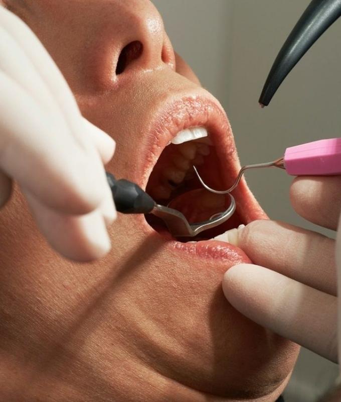 Countries agree to phase out mercury tooth fillings by 2034 under Minamata Convention