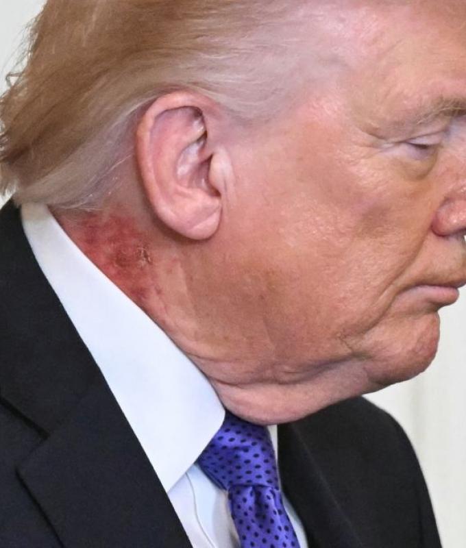 Trump’s new neck rash goes viral, White House doctor calls it ‘preventative’ care