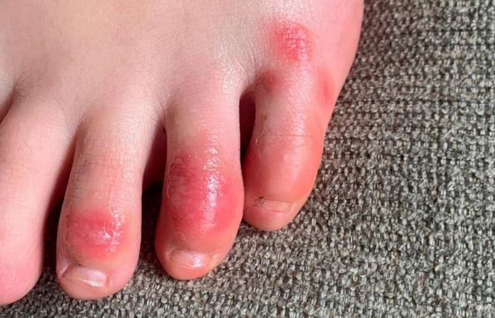Study supports link between coronavirus and 'Covid toes'