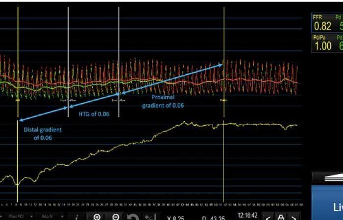 FFR Insights before and after PCI: Fresh food for thought