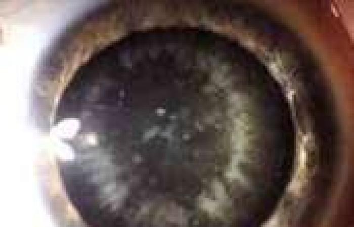 Does corona penetrate the body through the eyes? Results leave...