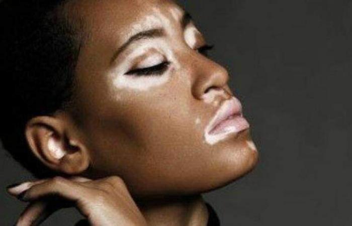 El Gouna movie about Vitiligo, explains its causes and symptoms. Get...