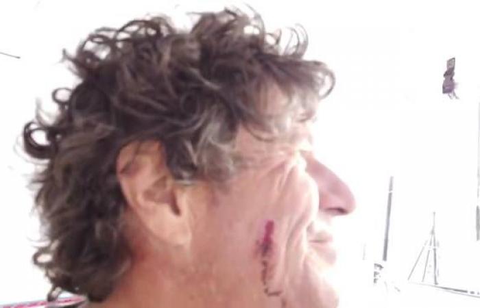 Nasty wound to the face for Jean Le Cam after the attack of a flying fish (yes, yes)
