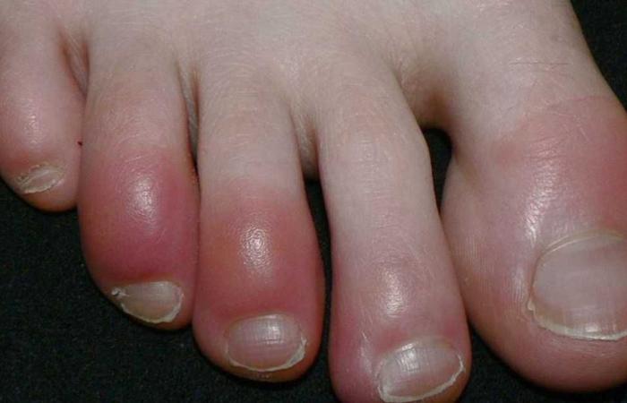 Changed toenails are evidence of a ‘silent killer’