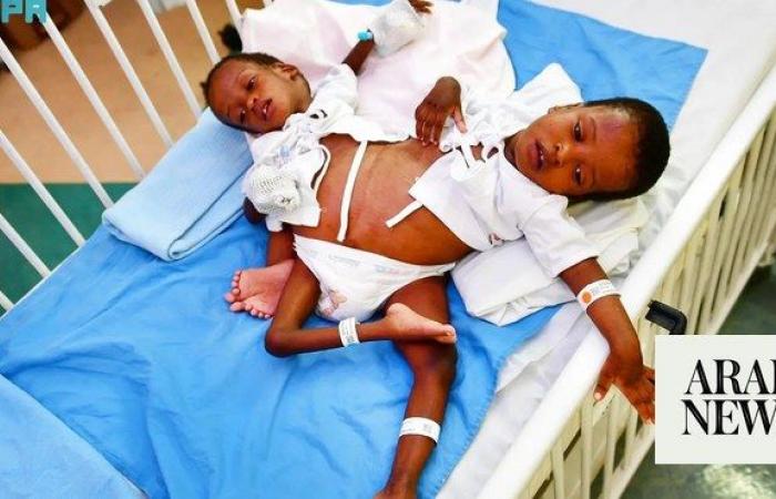 Saudi experts to separate conjoined Tanzanian twins