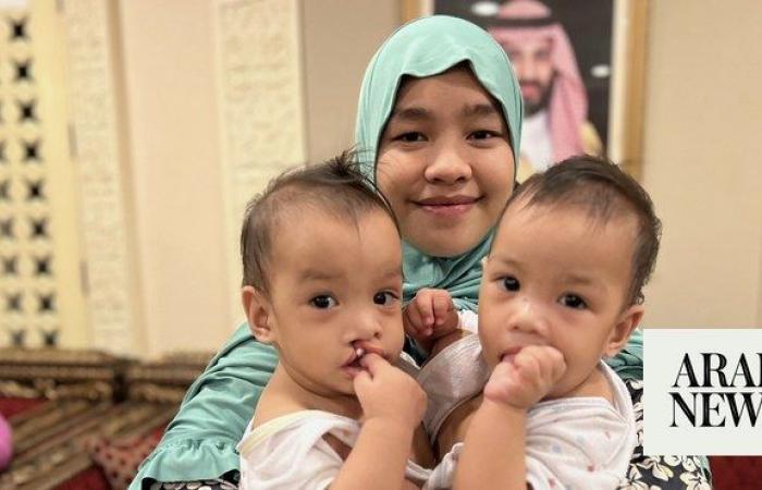 Saudi team in Manila to transport Filipino conjoined twins for surgery in Riyadh