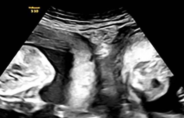 Woman with rare double uterus gives birth to twins