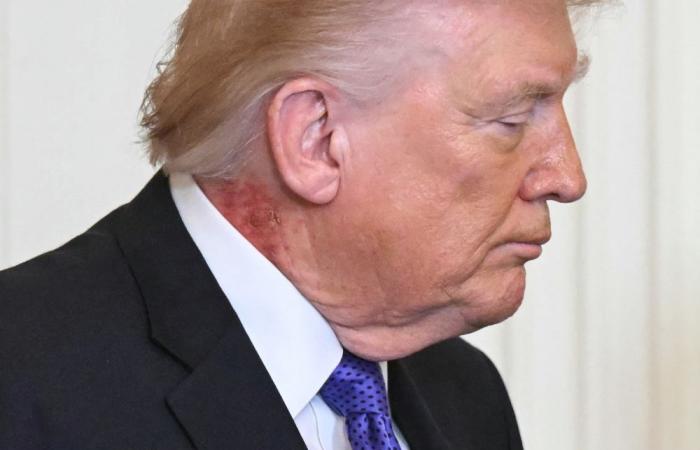 Trump’s new neck rash goes viral, White House doctor calls it ‘preventative’ care