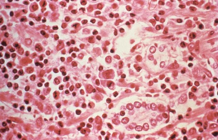 WHO says hantavirus outbreak ‘limited’, warns more cases possible after cruise ship deaths