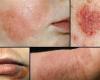 News 24 | Painful Eczema of the Skin … Symptoms,...