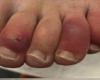 Toes discoloration … a new symptom of corona virus