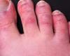 “Covert fingers” can last up to 150 days in patients, study...