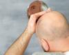 Bald men are more susceptible to Corona