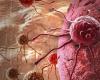 A side effect of immunotherapy could signal improved kidney cancer control
