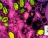 Kenya reports first mpox case