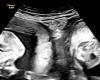 Woman with rare double uterus gives birth to twins