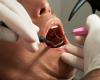 Countries agree to phase out mercury tooth fillings by 2034 under Minamata Convention